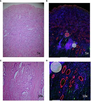 Digital spatial profiling identifies molecular changes involved in development of colitis-associated colorectal cancer